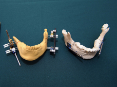 外置牽引成骨器系統(左)及內置牽引成骨器系統(右)   