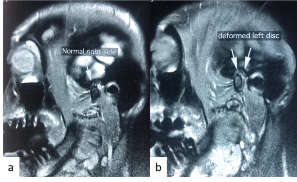 A patient with asymptomatic right TMJ and painful left TMJ with clicking upon opening. Magnetic resonance image shows a) normal TMJ and b) deformed articular disc at left TMJ.