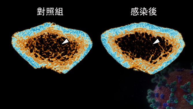 SARS-CoV-2 infection induces continuous inflammatory bone loss during both the acute and post-recovery phases of COVID-19. The 3D reconstructed micro-CT scans reveal that the bone trabecula (white arrow) density in the femur of SARS-CoV-2-infected hamsters (Right) is significantly lower than that of the Mock control (Left).
 