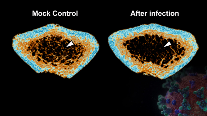 SARS-CoV-2 infection induces continuous inflammatory bone loss during both the acute and post-recovery phases of COVID-19. The 3D reconstructed micro-CT scans reveal that the bone trabecula (white arrow) density in the femur of SARS-CoV-2-infected hamsters (Right) is significantly lower than that of the Mock control (Left).
 