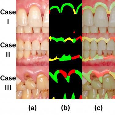 I. Intraoral photograph.
II. Health status labelled by a calibrated dentist (green=healthy, red=diseased, yellow=questionable)
III. AI detection results.
 