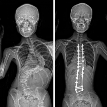 Currently, the treatment options for AIS are limited to bracing and invasive surgery once the condition has developed. The x-ray photos depict an AIS patient before (left) and after surgery.
 