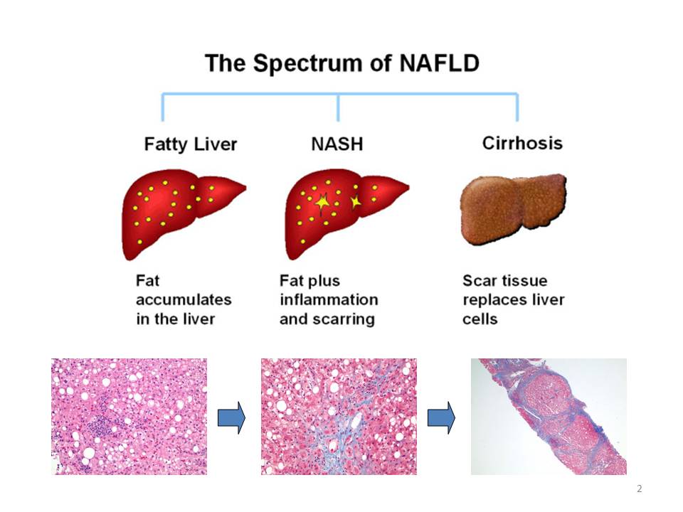Image result for nonalcoholicfattyliver disease